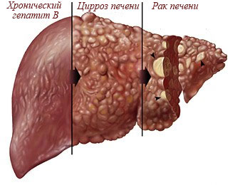 Хронический гепатит Б - цирроз - рак печени