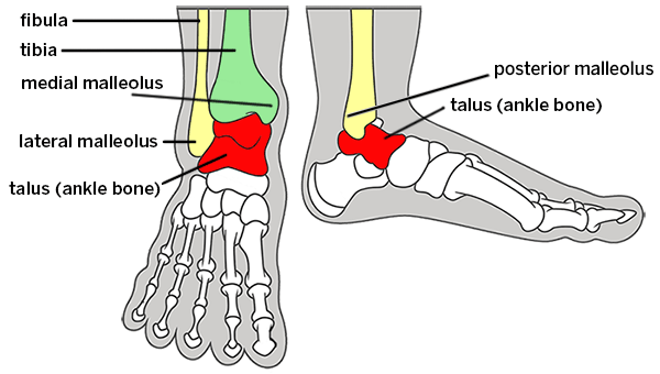 Graphic showing bones of the ankle with labeling of the fibula, tibia, medial malleolus, lateral malleolus, posterior malleolus and talus (ankle bone).