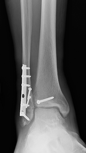 X-ray image showing front view of fixation of the fibula and posterior malleolus with restoration of the joint congruity.