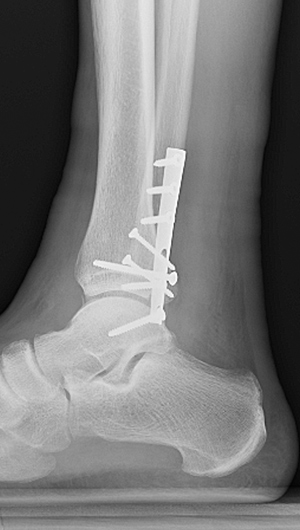 X-ray image showing side view of fixation of the fibula and posterior malleolus with restoration of the joint congruity.