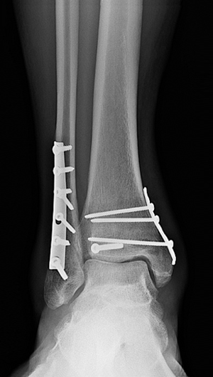 X-ray image of surgical plates and screws to treat a trimalleolar fracture