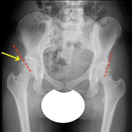 anterior to posterior (front to back) X-ray showing hip dysplasia in the right hip