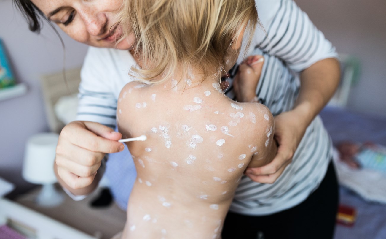 Mother applying ointment to child with chickenpox