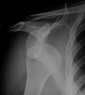Рентгенография при вывихе плеча