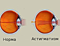 Гиперметропический астигматизм