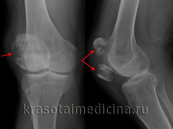 Рентгенография коленного сустава. Перелом надколенника с выраженным диастазом отломков.