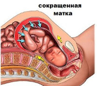 Повышенный тонус матки при беременности