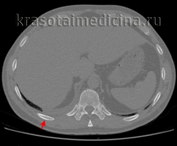 КТ органов грудной клетки. Перелом 7-го ребра справа без смещения отломков.