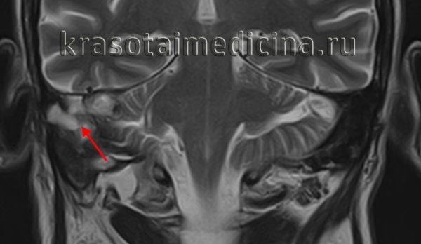 МРТ головы. Гиперинтенсивный сигнал в области сосцевидной пещеры, сосцевидного отростка и пирамиды правой височной кости (холестеатома)