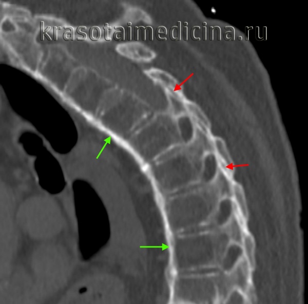 КТ грудного отдела позвоночника. Сращение суставных фасеток позвонков (красная стрелка), с оссификацией передней продольной связки («стебель бамбука»).
