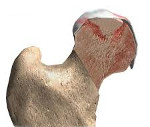 Асептический некроз головки бедренной кости