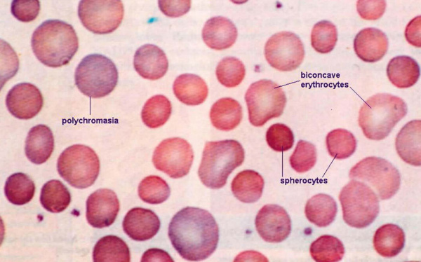 Наследственный микросфероцитоз