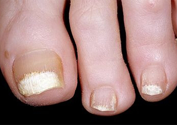 Симптомы псориаза: ухудшение состояния ногтей