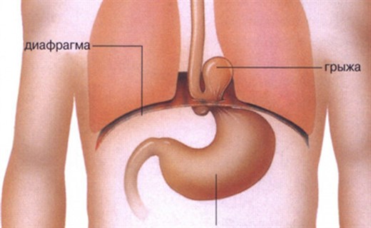 Грыжа диафрагмального отверстия