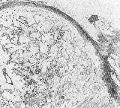 Микроскопическая картина гранулемы пиогенной