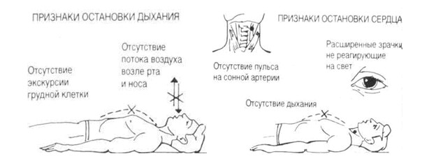 Признаки остановки сердца и дыхания