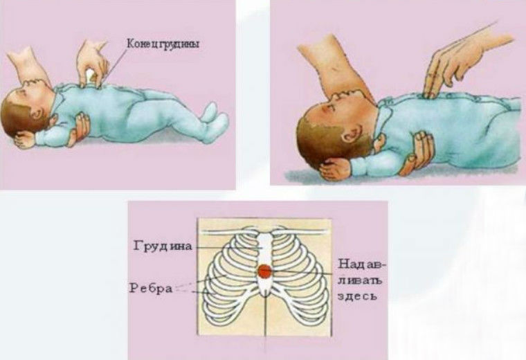 Остановка сердца и дыхания у новорожденных и детей старше - первая помощь