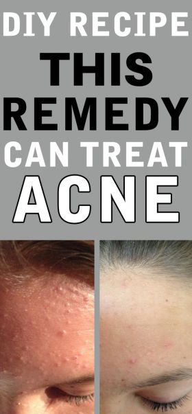 hydrogen peroxide for acne