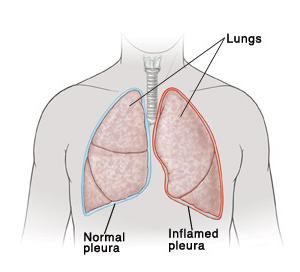 лечение плеврита лёгких