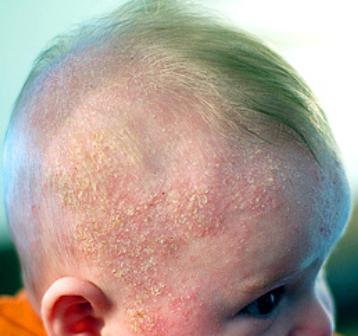 Как выглядит потница у новорожденных на голове, фото