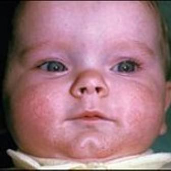 Как выглядит потница у новорожденных на лице