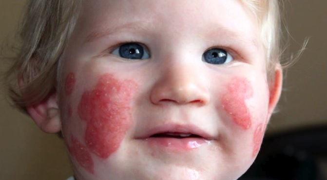 Атопический дерматит у детей фото на щеках