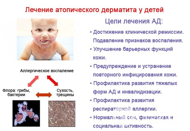 лечение атопического дерматита у детей