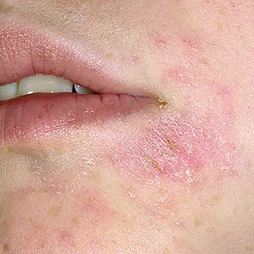 Аллергия - прыщи и шелушение