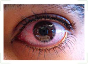 Эписклерит глаза