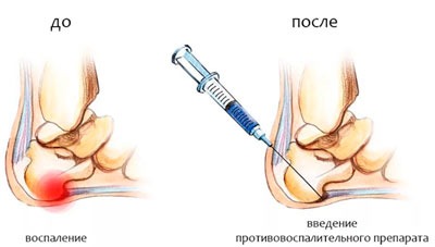 Блокада пяочной шпоры