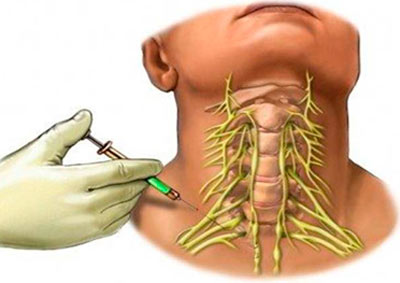 блокада лечебная методика