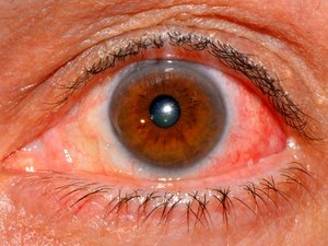 Особенности заболевания эписклерит глаз