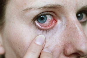 Перечень симптомов эписклерита глаз