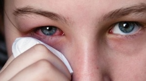 Причины заболевания эписклерит глаз